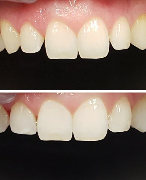 Man with flawless smile after cosmetic dental bonding