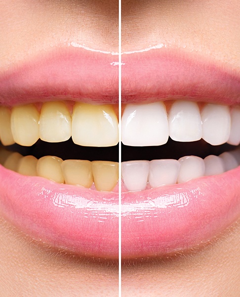 Smile before and after teeth whitening