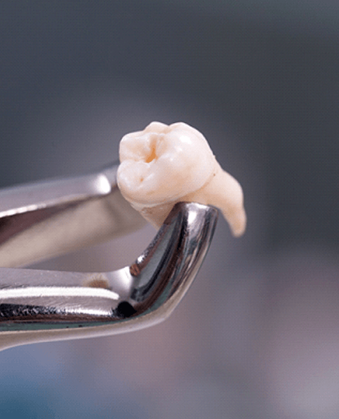 Close-up of extracted tooth gripped in forceps