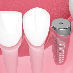 Digital illustration of dental implant in Denver