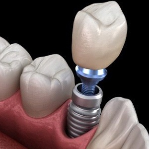 A single dental implant in Collegeville located in the lower arch of the mouth