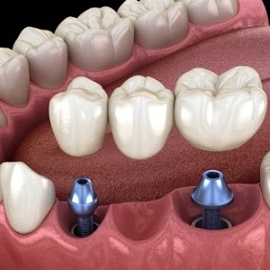 A digital image showing a dental implant bridge sitting in the lower arch in Collegeville