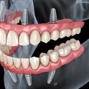 A digital scan of four dental implants on the lower and upper arches of the mouth and full dentures attached in Collegeville