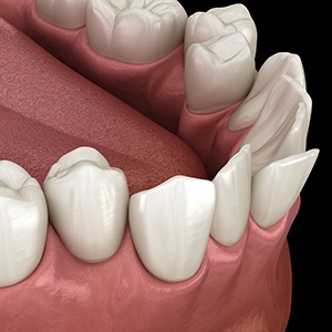 Illustration of crooked teeth