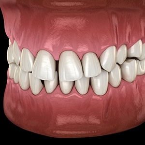 Illustration of gapped teeth