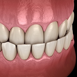 Illustration of an underbite