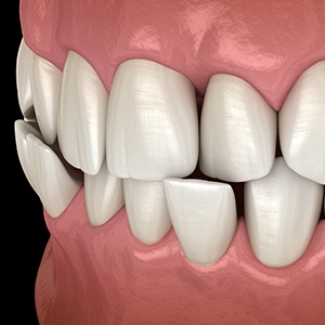 Illustration of a crossbite