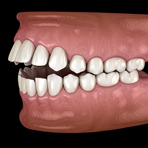 Illustration of an open bite