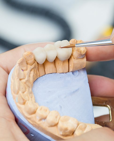Model smile with dental bridge restoration