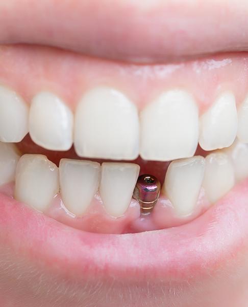 Smile with dental implant post visible