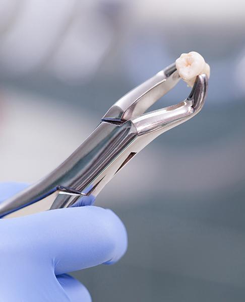 Metal clasp holding an extracted tooth