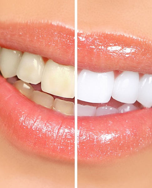 Closeup of patient's smile before and after teeth whitening treatment