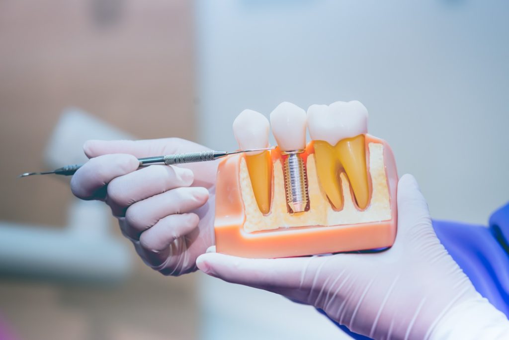 Dentist pointing to model of dental implants